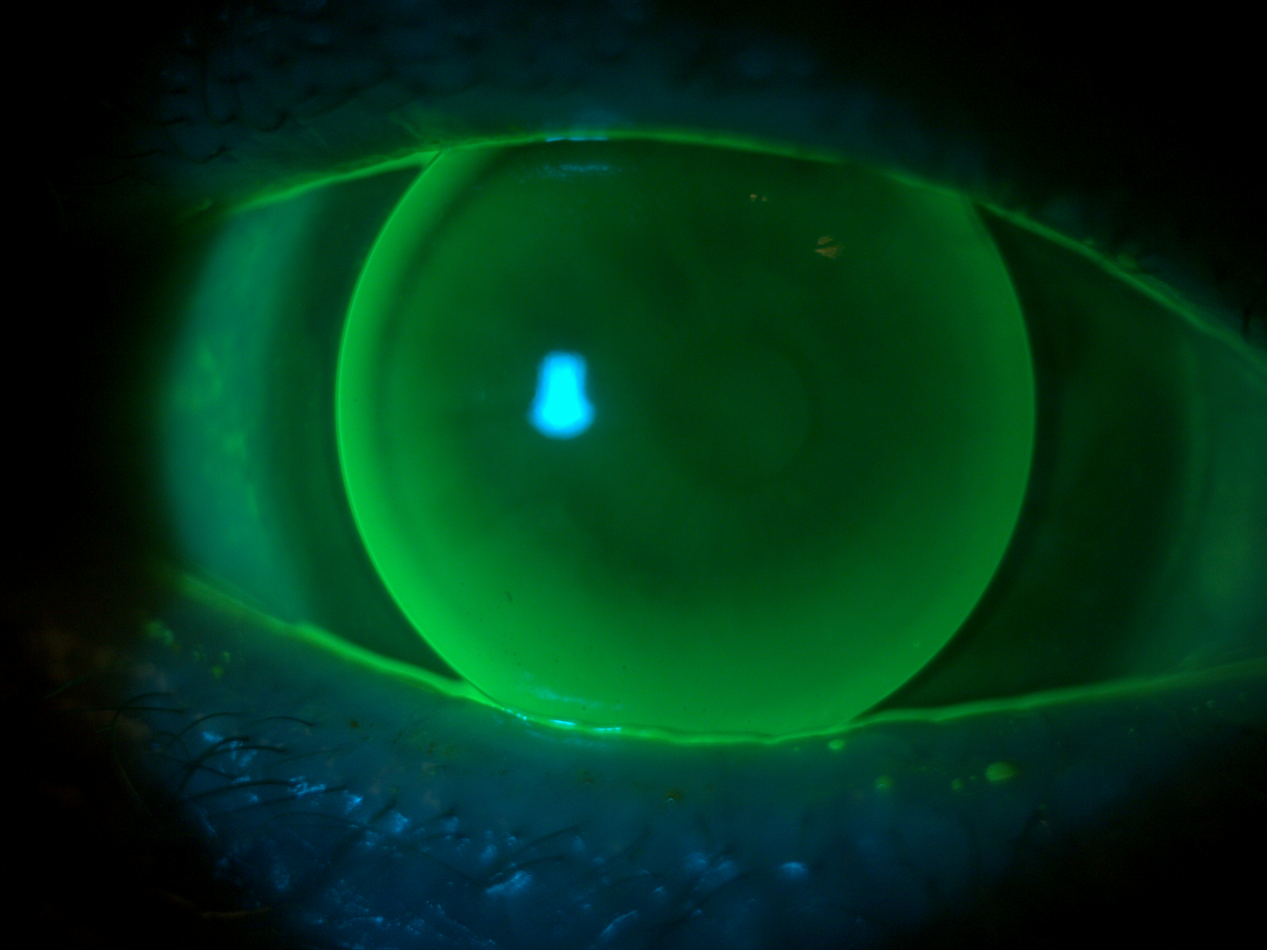 GP Lens on Eye