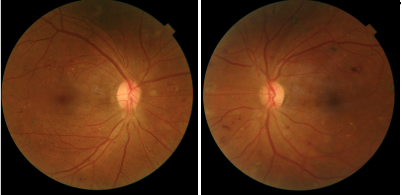 Severe diabetic retinopathy fundus