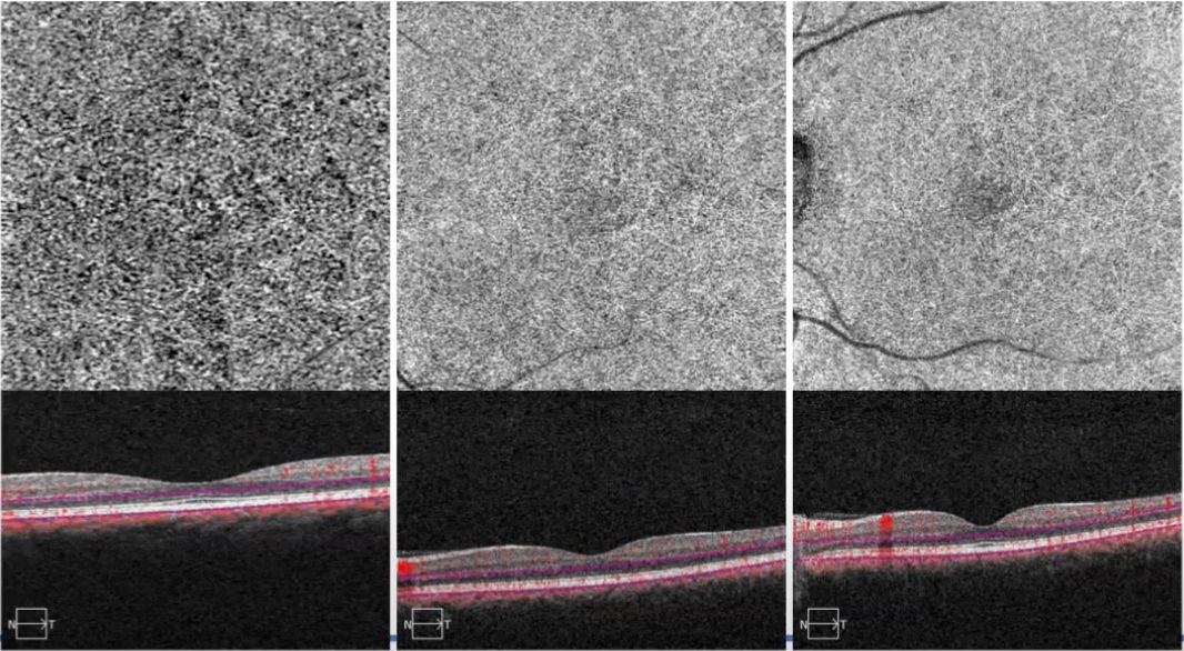 OCTA outer retina to choriocapillaris slab view