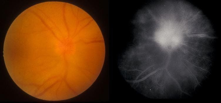 Figure 7: Presentation of posterior uveitis secondary to syphilis with optic disc swelling (left) associated with extensive leakage on angiography (right).