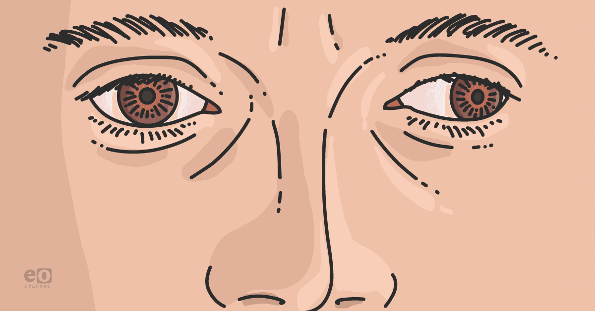 Closeup of a patient with misaligned eyes due to amblyopia.