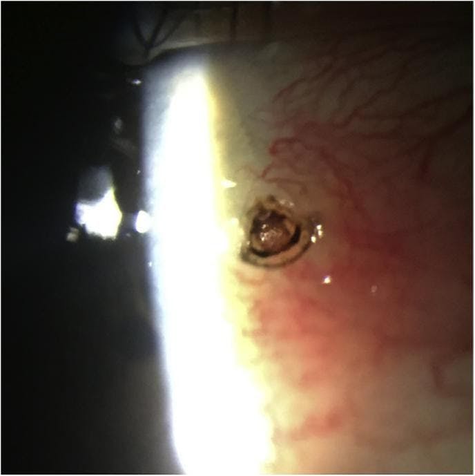 Figure 2: Slit-lamp visualization of the Ixodes tick larvae attached to the nasal conjunctiva of the patient's right eye 1.5 mm posterior to the limbus. There was 2 + conjunctival injection and prominent episceral vessels. Adapted with permission from Kuriakose RK Grant LW Chin EK Almeida DRP. Deer tick masquerading as pigmented conjunctival lesion. Am J Ophthalmol Case Rep. 2016;5:97-98. doi:10.1016/j.ajoc.2016.12.018