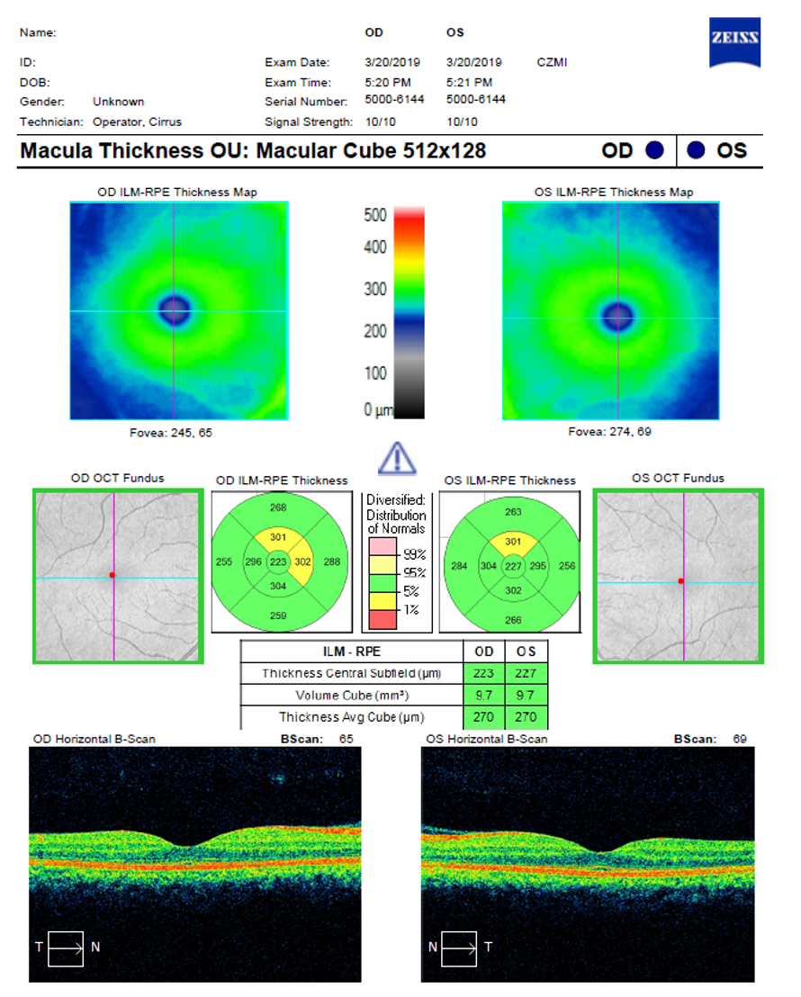 In this OCT diagnostic report the top box indicates where identifying patient information and signal strength scores are located.  The second box identifies the topographical retinal thickness map for each eye.  The next box highlights the quantitative or numerical thickness map for each eye.  The bottom box indicates where the B-scan image for each eye can be found.  This image depicts the use of a pseudo-color scale