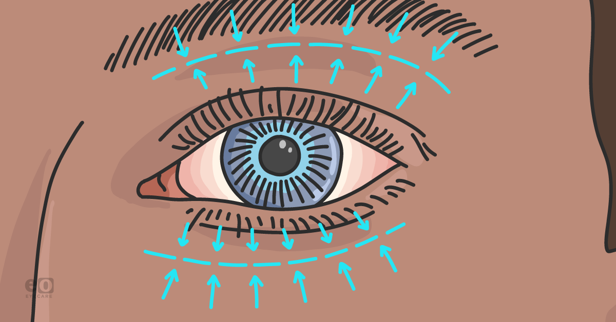 What Optometrists Should Know About Cosmetic Eyelid Surgery