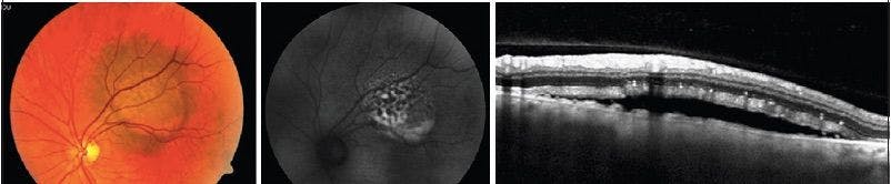 Fundus and OCT of Serous Retinal Detachment
