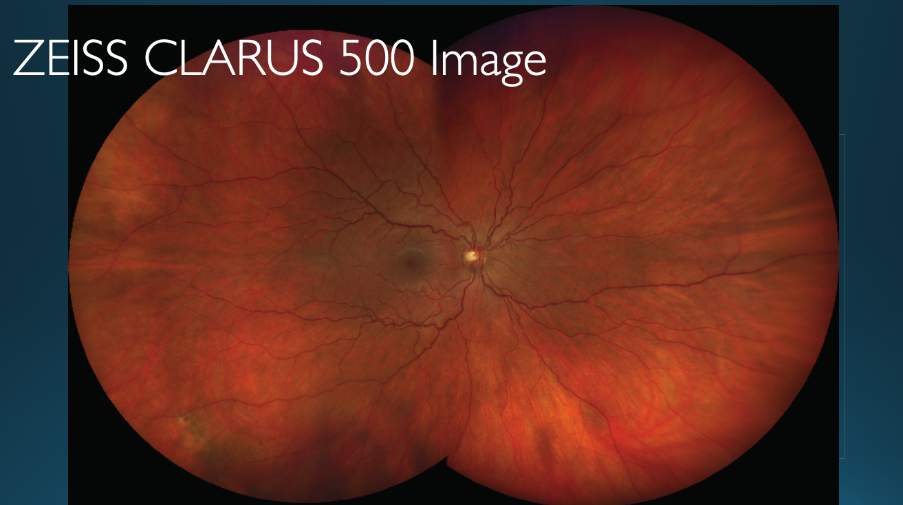Figure 8 shows patient’s right eye taken with the ultra-widefield camera and reveals a small atrophic retinal hole in the inferior temporal quadrant of the retina.