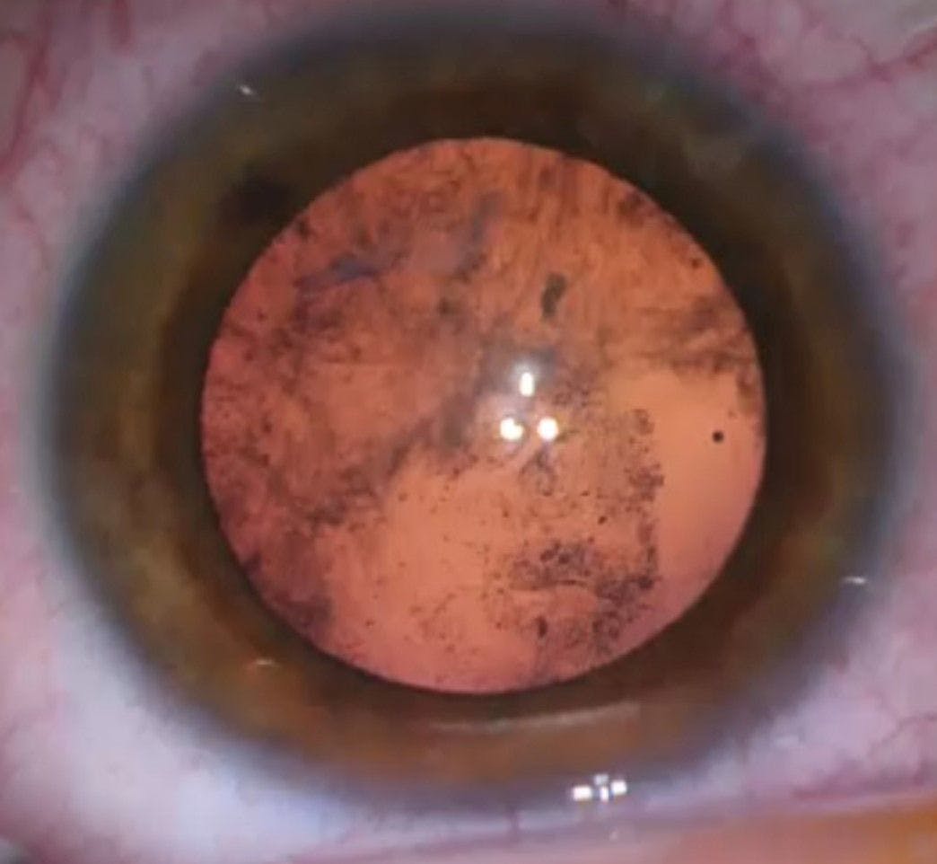 Subcapsular cataract