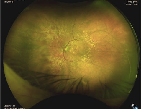 GA Retinal Diffusion