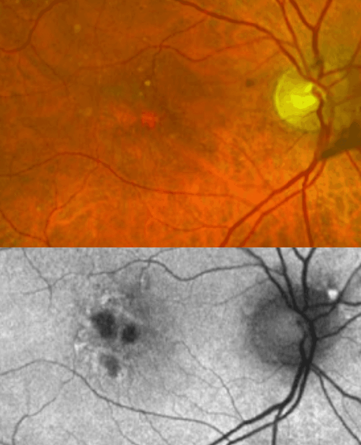 Injection Atrophy A New Practice Pattern for Geographic Atrophy