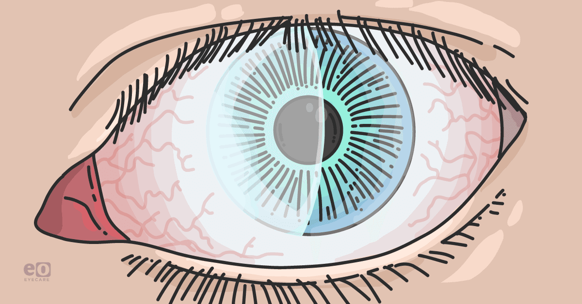 Closeup of an eye with Fuchs' endothelial corneal dystrophy that received a DMEK and light adjustable lens (LAL) implant.