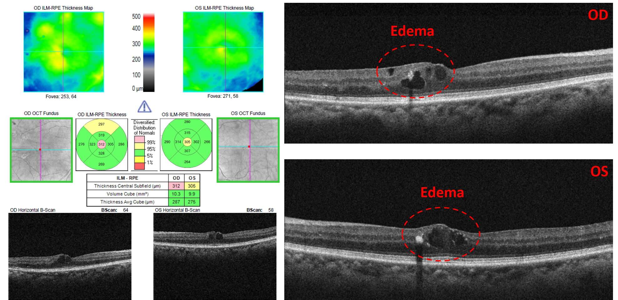 center-involving diabetic macular edema