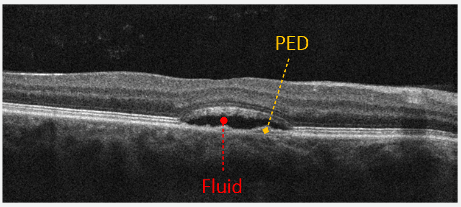A serous detachment of the macula is accompanied by a PED in the presence of central serous chorioretinopathy.