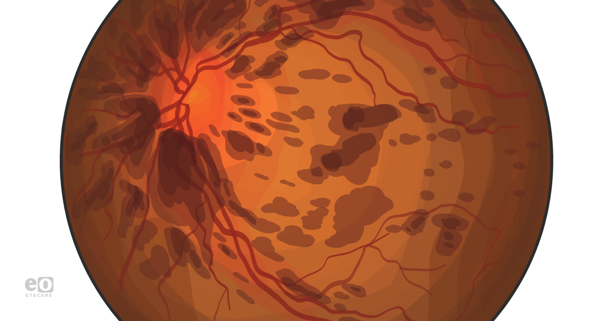 What Ophthalmology Residents Should Know About Flame Hemorrhages