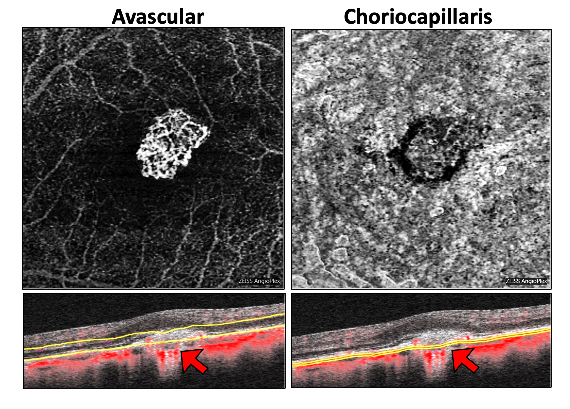 Sequential OCTA maps (above) and B scan blood flow overlay (below) showing Type 2 subretinal choroidal neovascularization in a highly myopic patient