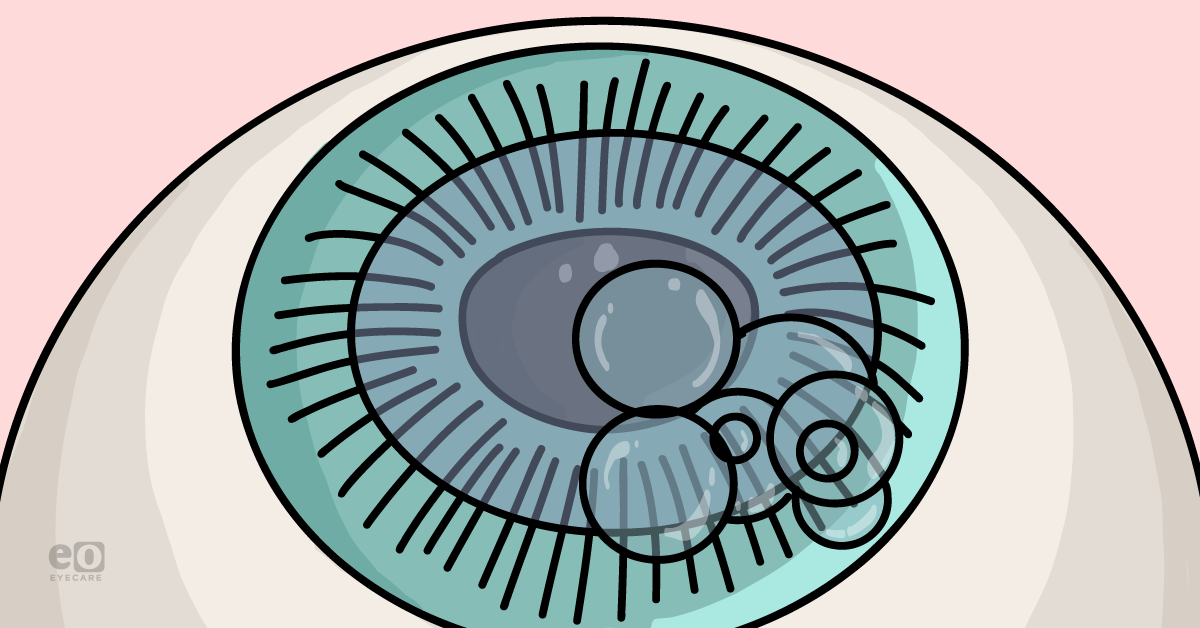 The Ophthalmology Resident’s Guide to DMEK (Descemet Membrane Endothelial Keratoplasty)