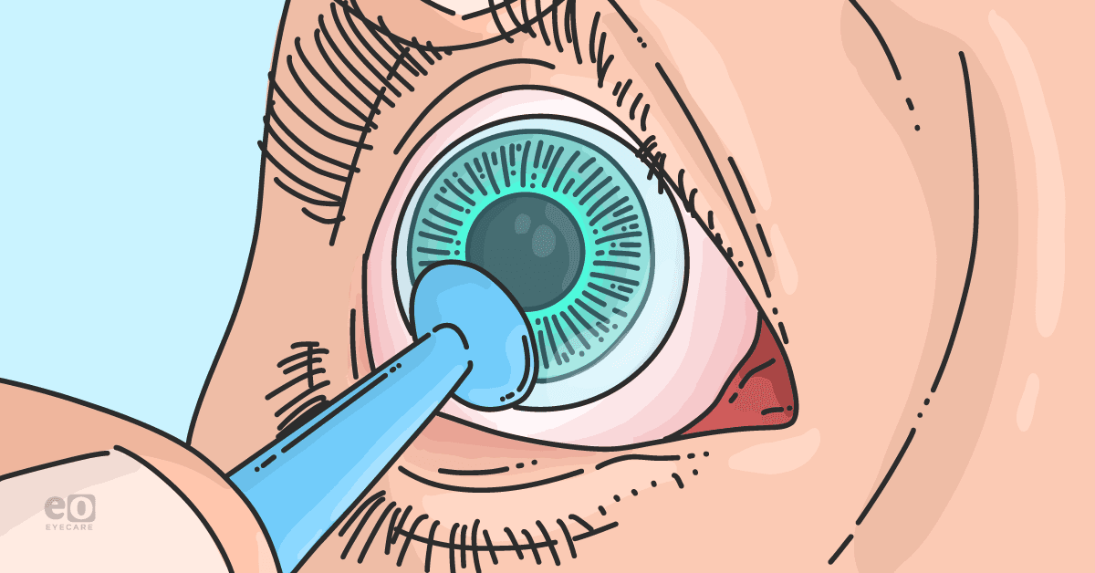 Closeup of a patient placing a scleral lens in their eye.