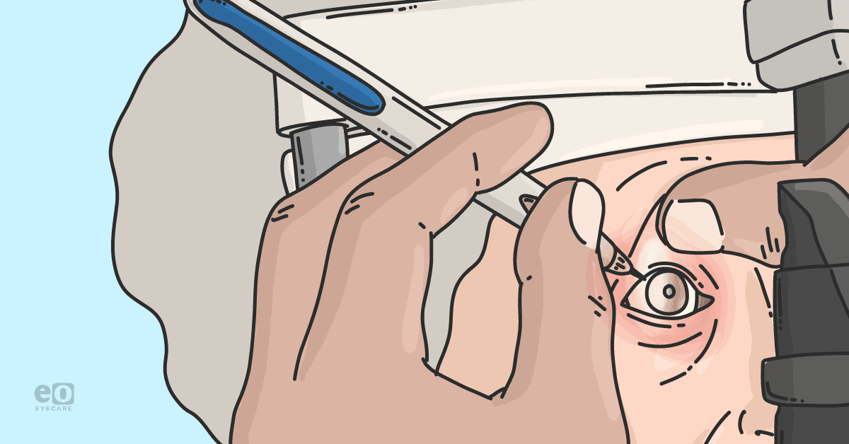 Glaucoma Now: The Latest in Prevalence and Progression