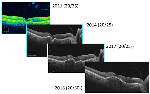 Dry AMD with drusenoid PED 2014-2018
