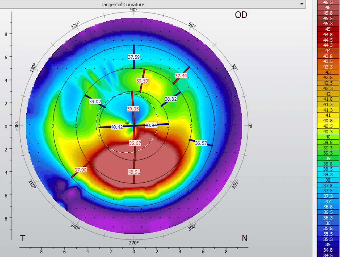 Catching the Curve: The Essentials to Early Keratoconus Diagnosis