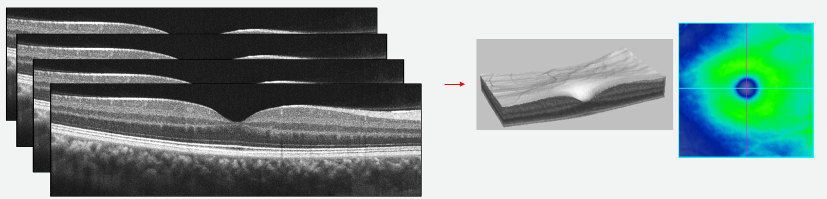 A cube scan is made up of many adjacent B-scans to create a 3D representation of the retina
