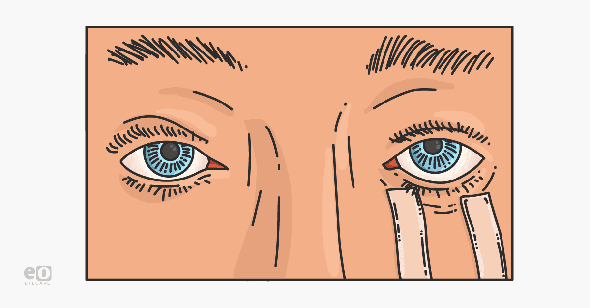Illustration of a patient's eyelid being pulled down by tape to help with symptoms caused by entropion.