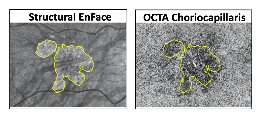 OCTA structural and microvasculature maps of the choriocapillaris
