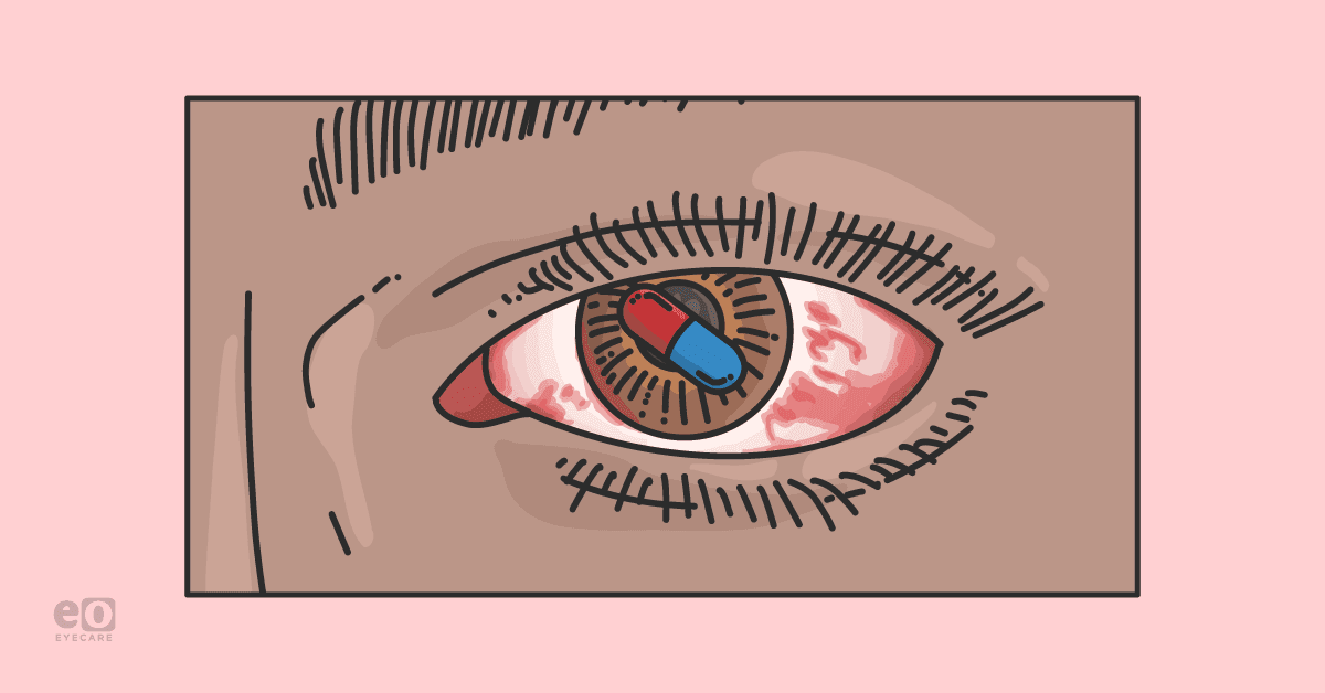 Closeup of a patient's red eye with a pill superimposed over the iris to represent drug-induced uveitits.