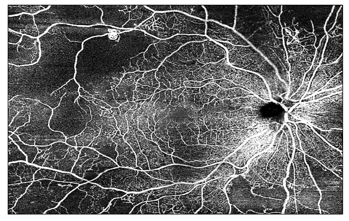 Ultra-widefield OCTA scan of right eye showingg signs of proliferative dr