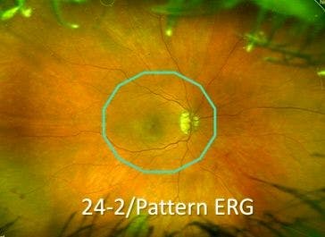 Retinal Image Visual Field