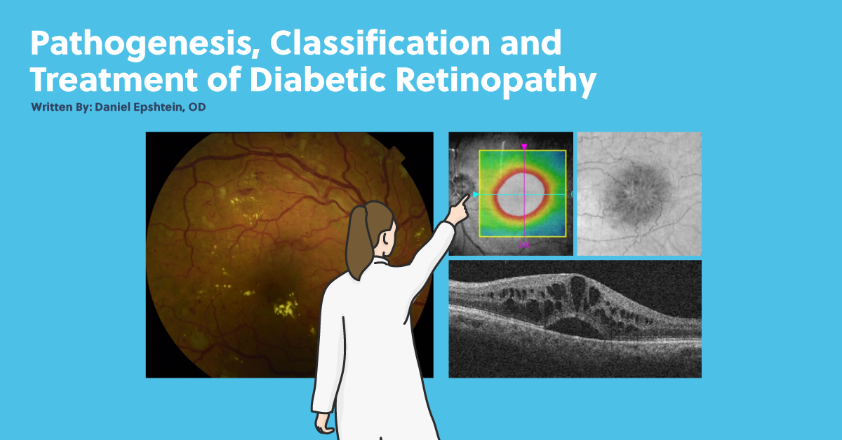 Pathogenesis, Classification, and Treatment of Diabetic Retinopathy