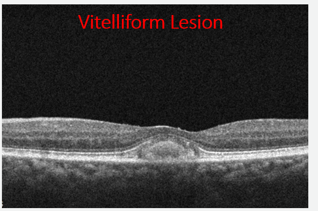 Note the distinct appearance of the vitelliform lesion.  Compare it to the drusen above