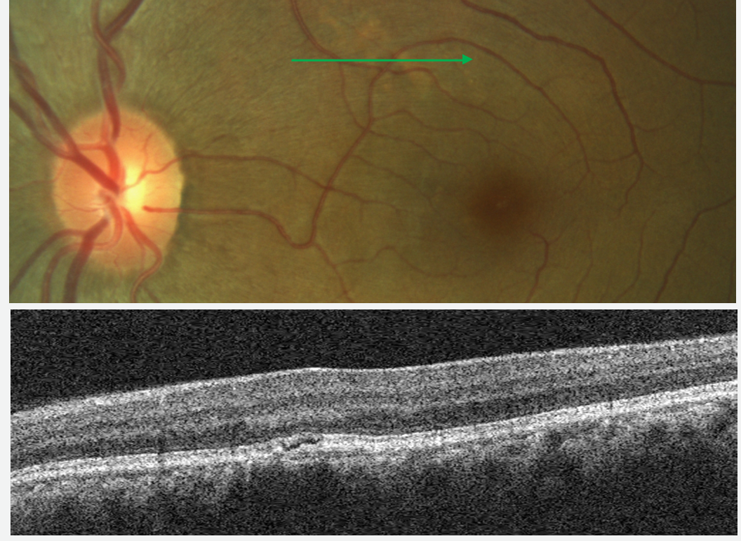 Pachychoroid Pigment Epitheliopathy:  The fundus photo shows a light colored lesion that may be confused for drusen in AMD while the B-scan image resembles the appearance of retinal edema.