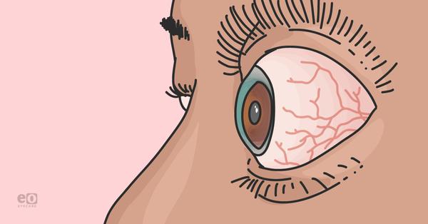 The Ultimate Guide to Thyroid Eye Disease