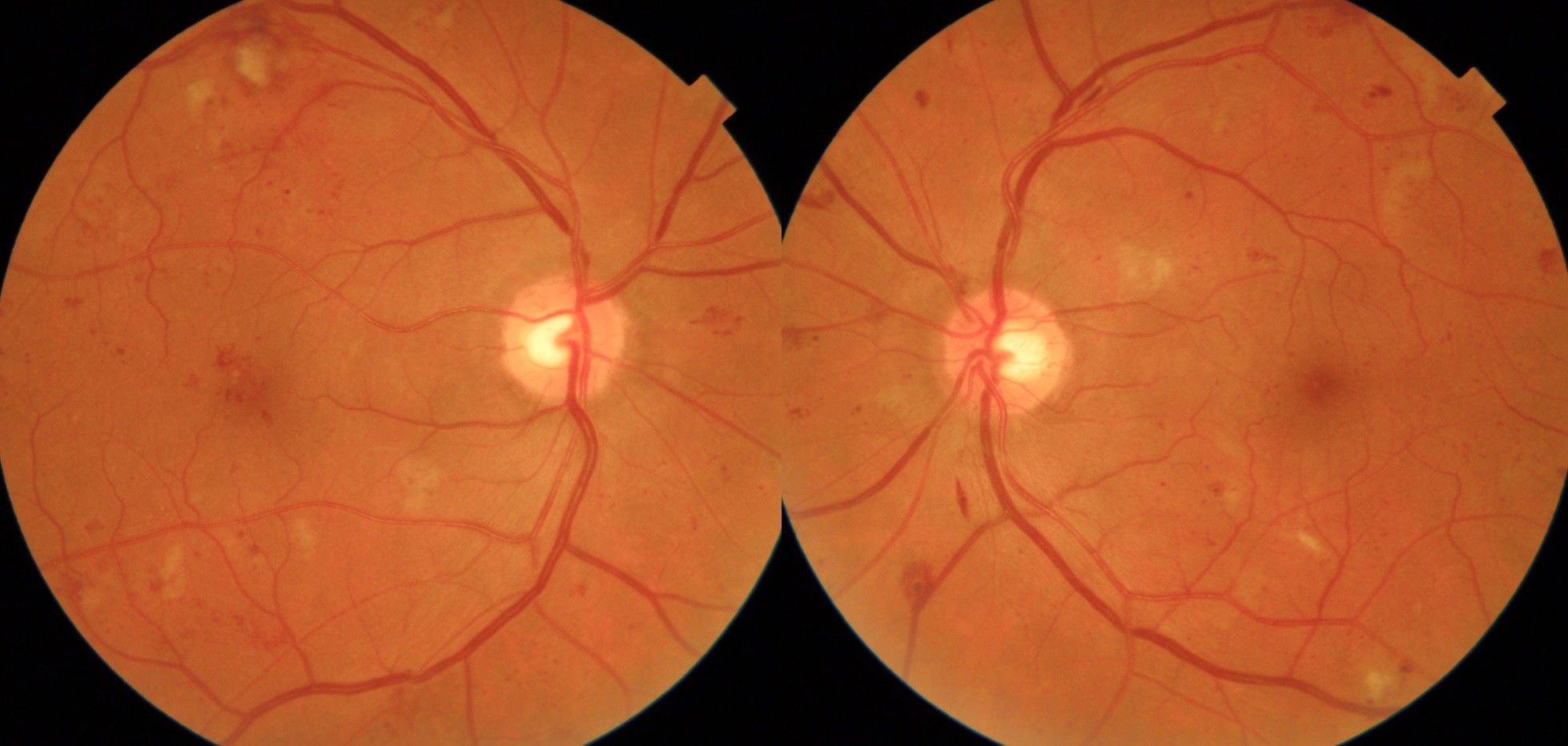 Diabetic retinopathy Fundus