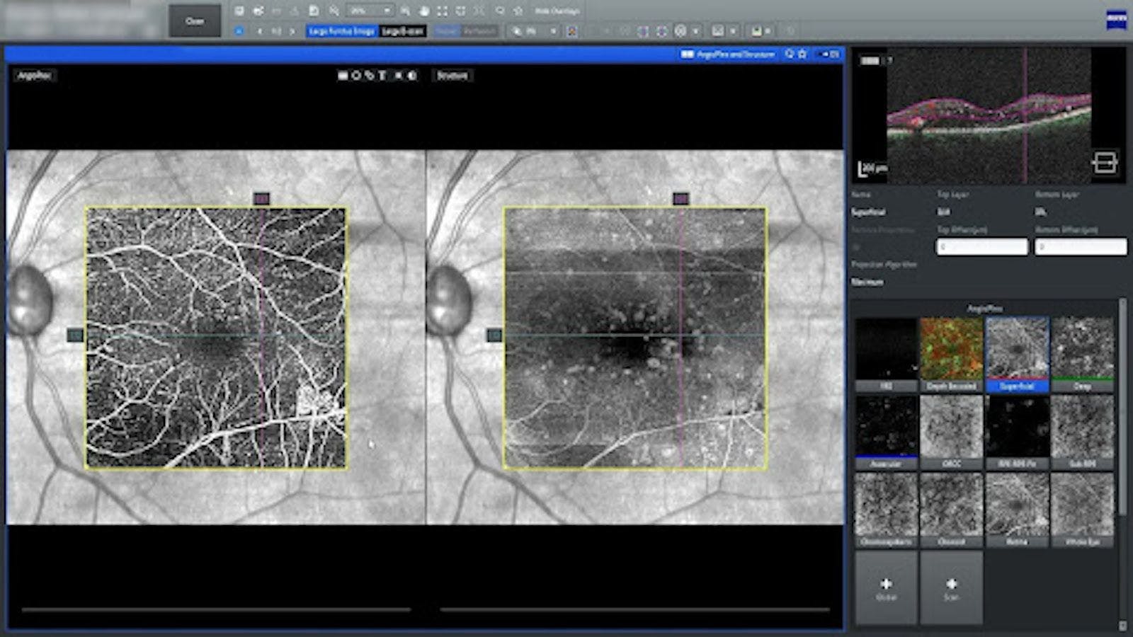 OCTA imaging of retinal and optic disc neovascularization