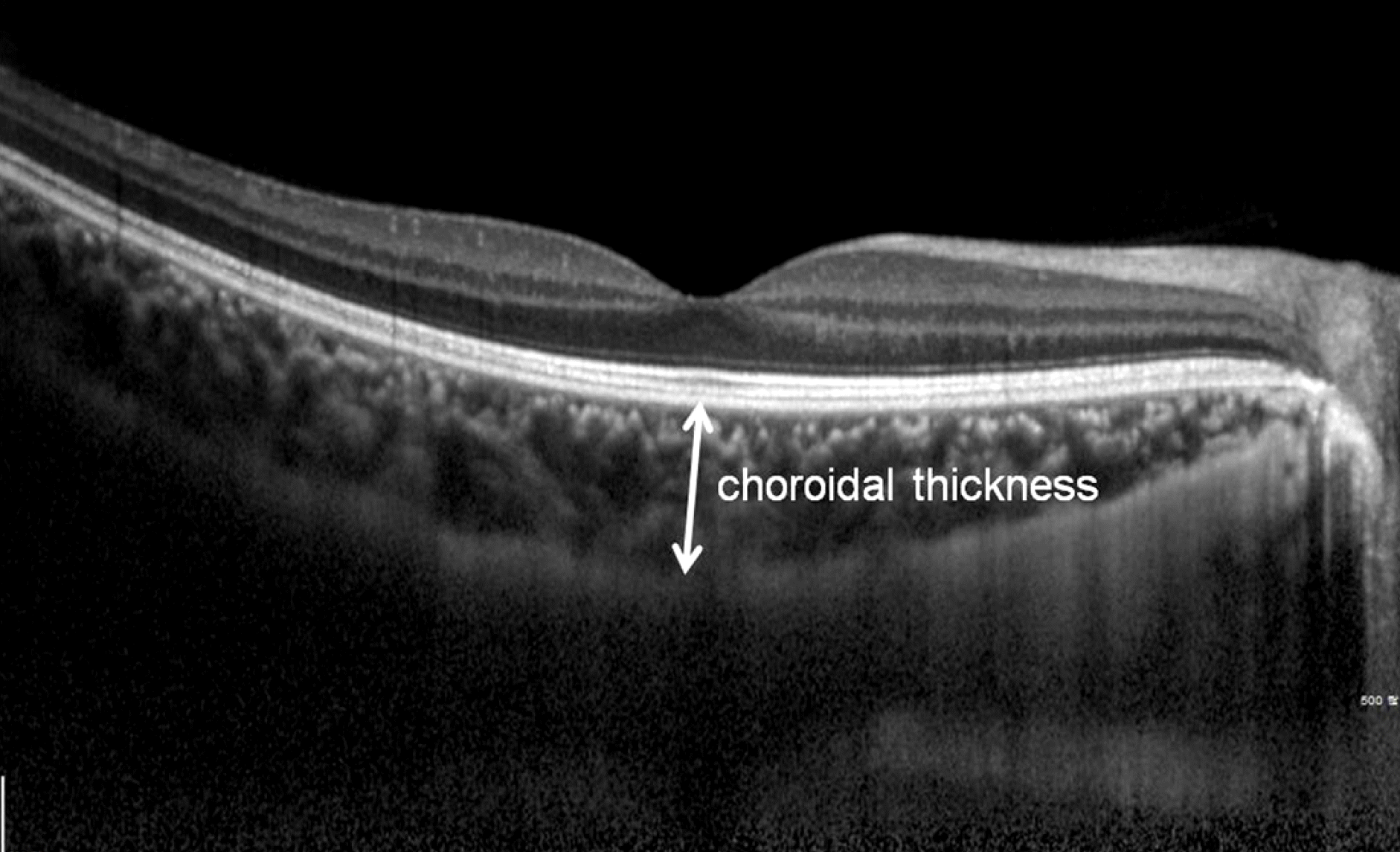 OCT choroidal thickness