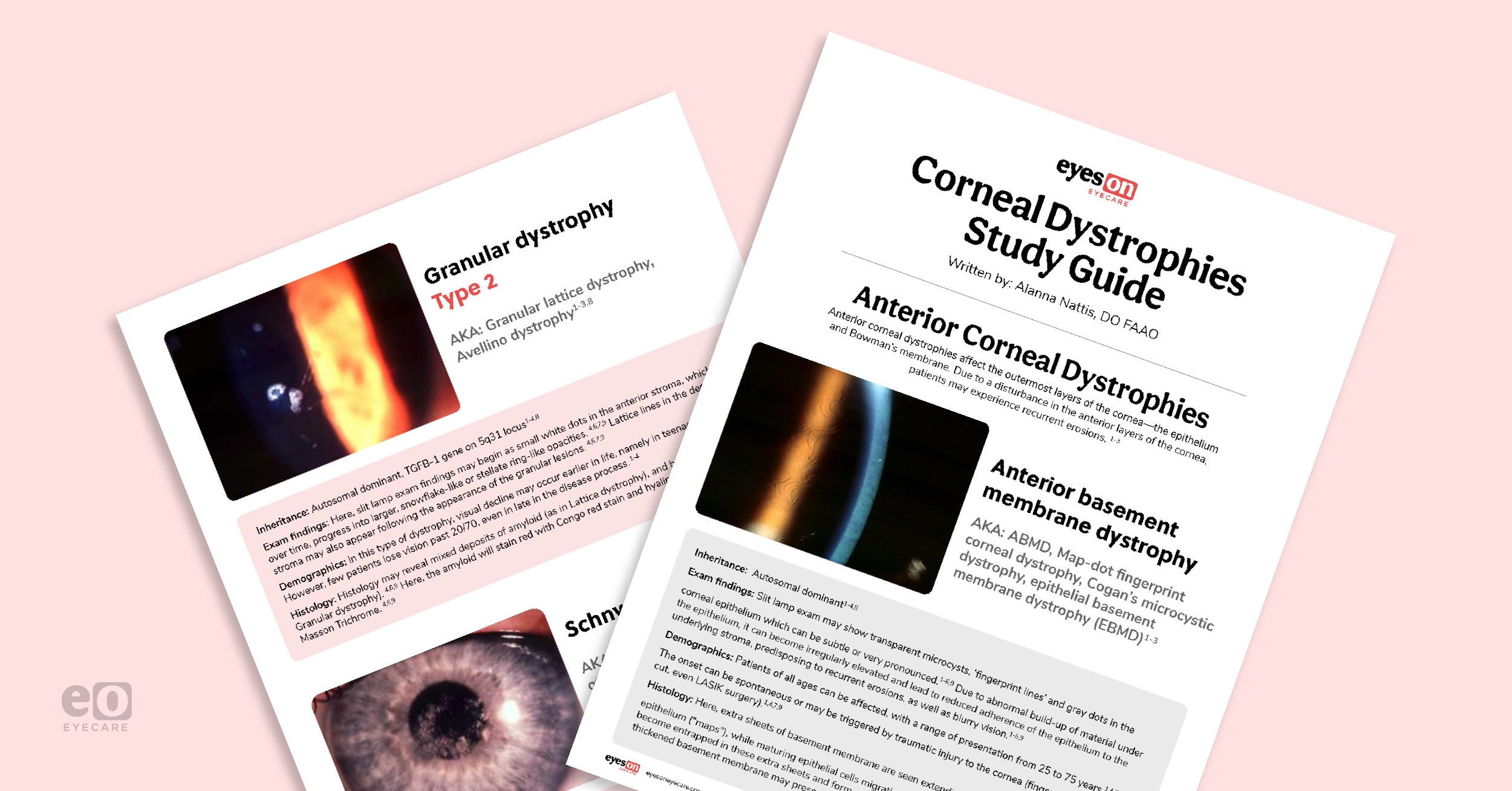 The Ultimate Corneal Dystrophies Study Guide