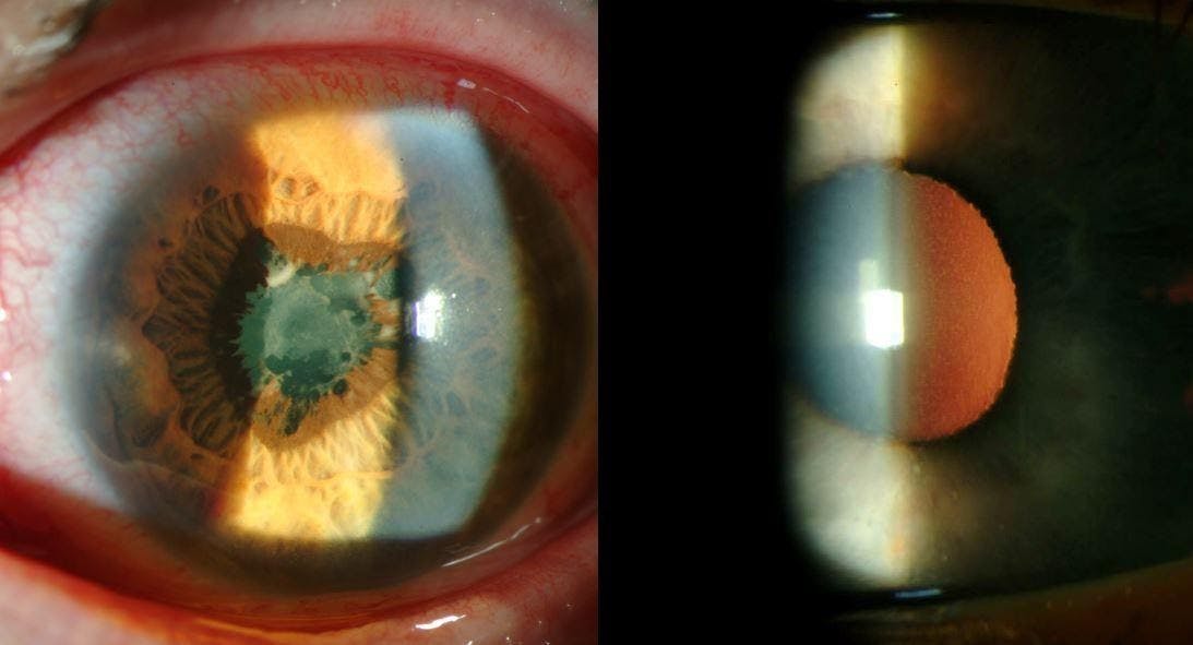 Figure 3: Presentation of idiopathic iridocyclitis with conjunctival injection anterior chamber reaction iris transillumination defects and posterior synechiae.