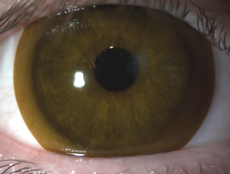 Green-tinted Contact Lens