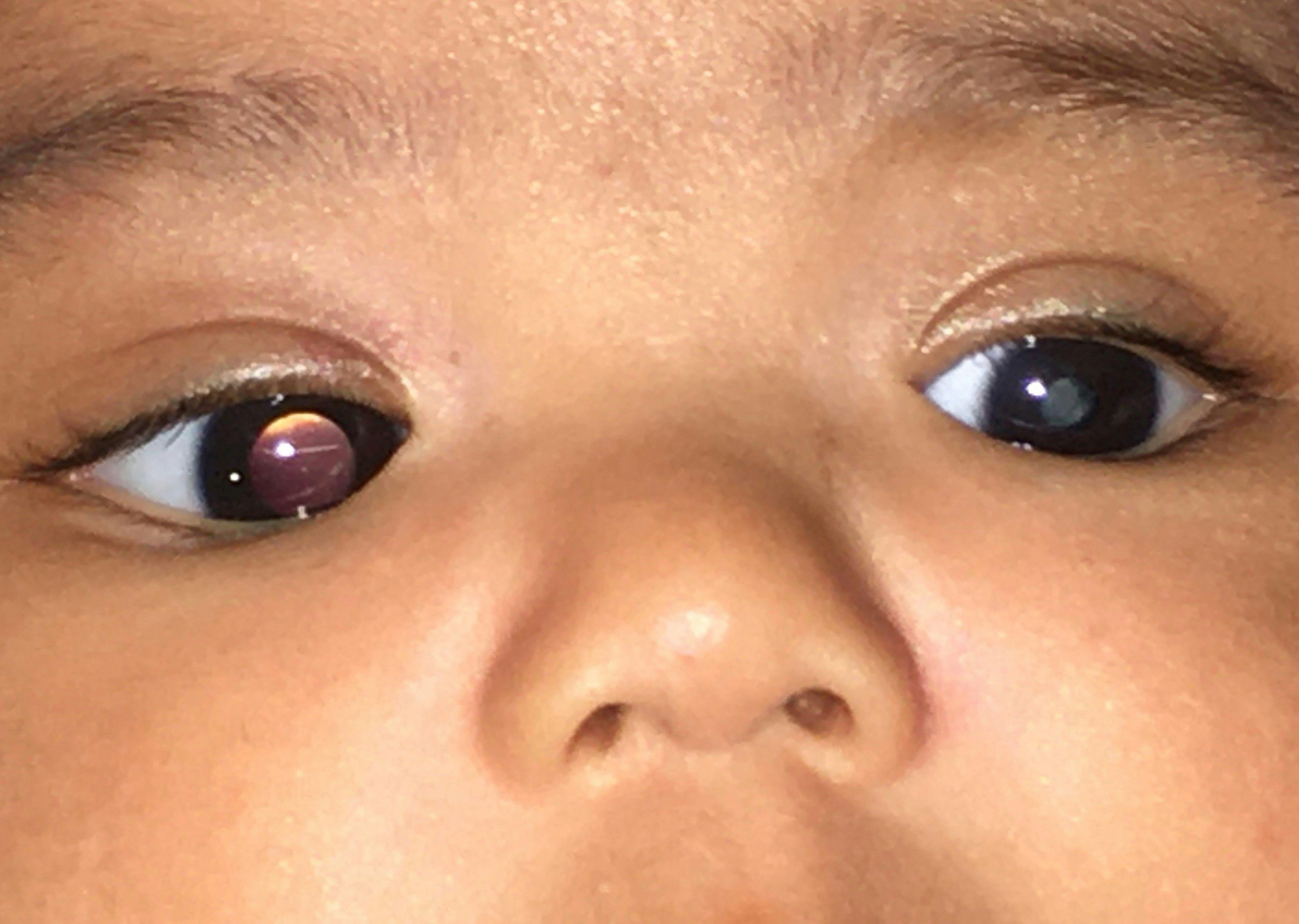 infant cataract
