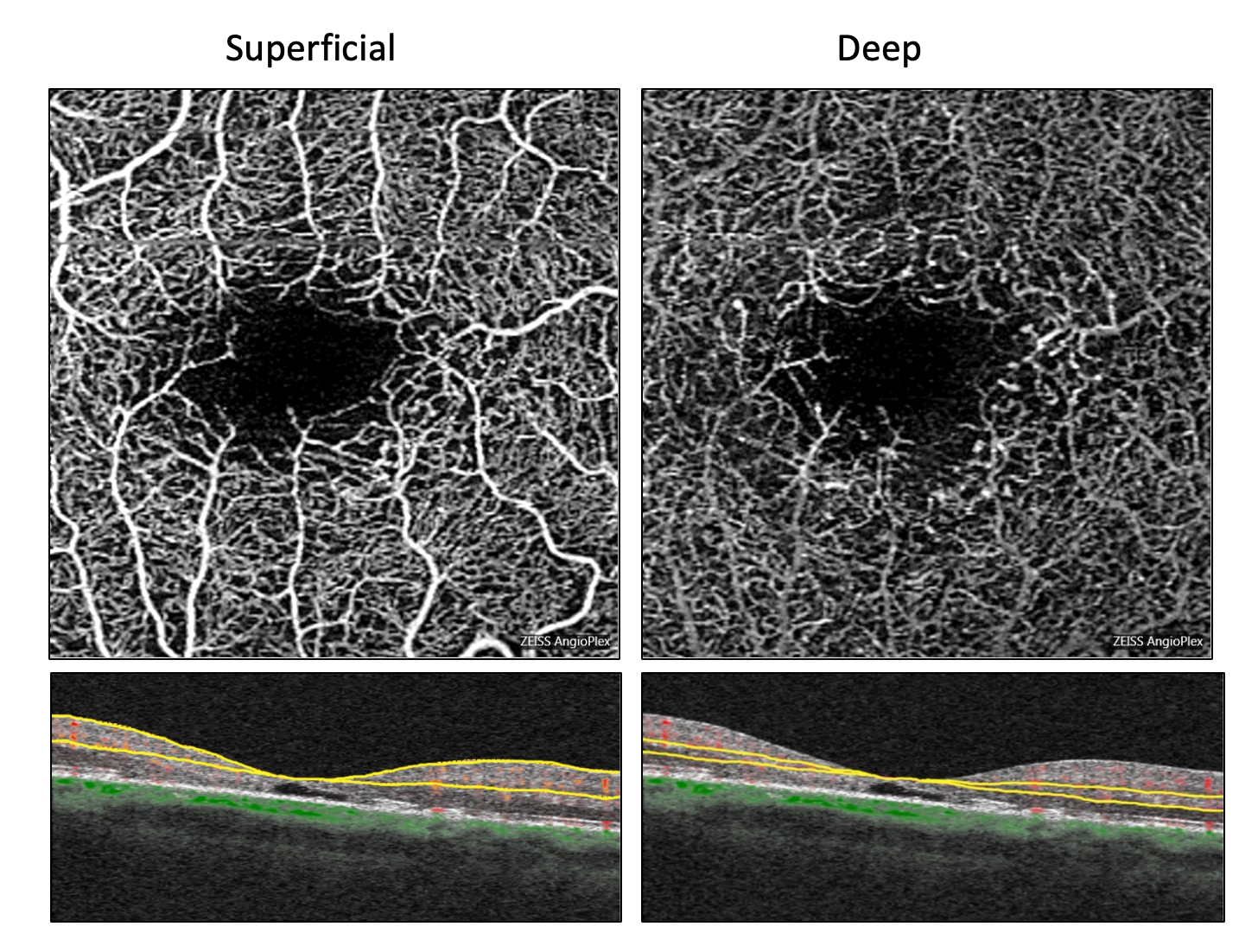 Superficial and deep 6x6mm OCTA retinal microvasculature maps 