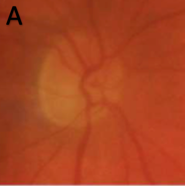 Ischemic Optic Neuropathy