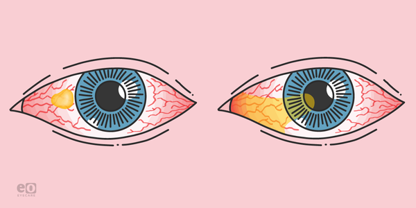 Pterygium vs Pinguecula: What to Know and How to Treat