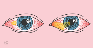 Pterygium vs Pinguecula: What to Know and How to Treat