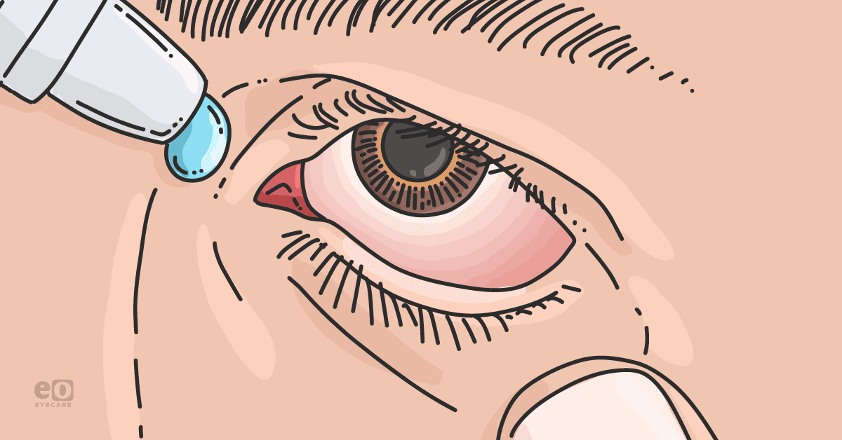Image of an individual with corneal abrasion instilling eye drops to main ocular surface lubrication.