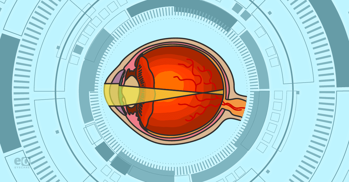 Image of a myopic eye surrounded by futuristic-looking computer circuitry to represent advances in AI in myopia management.