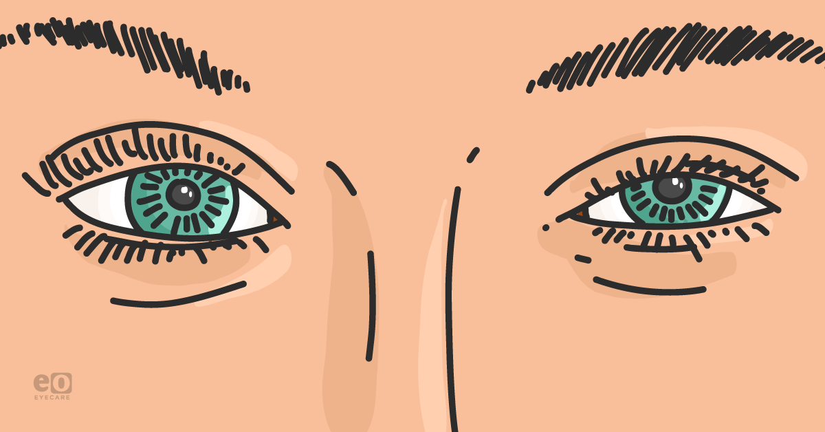 The Ultimate Guide to Assessing Eyelid Ptosis