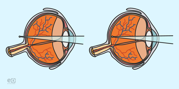 Prescribing for Hyperopia: Quick Tips for New Optometrists