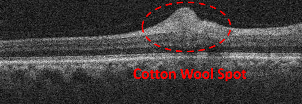 cotton wool spot