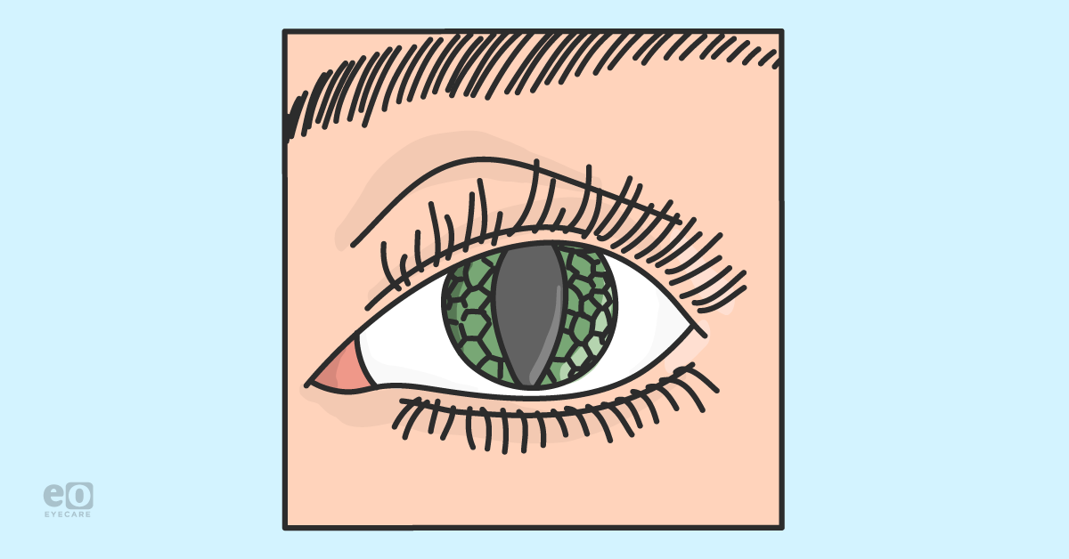 The Optometrist's Guide to Color and Costume Contacts